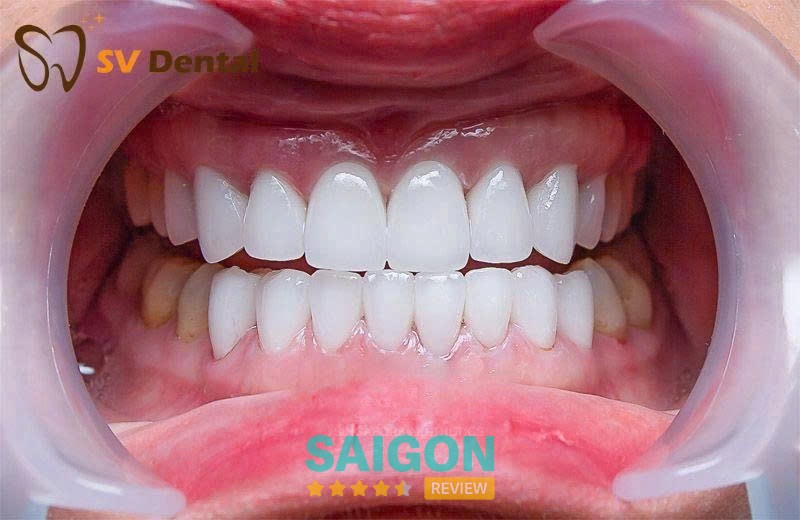 Nha Khoa SV Dental – hình ảnh 3